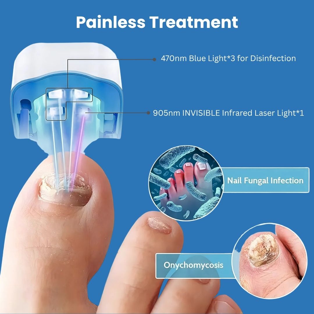 FungeeFree™ - Nail Fungus Laser