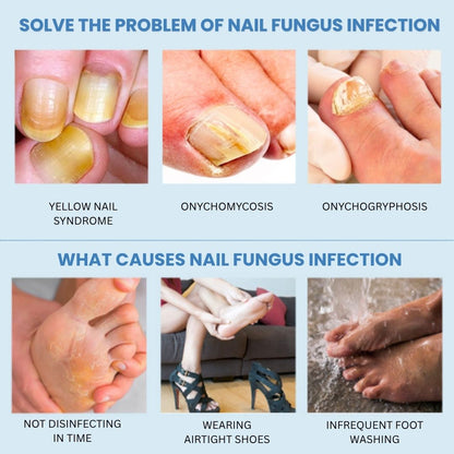 FungeeFree™ - Nail Fungus Laser