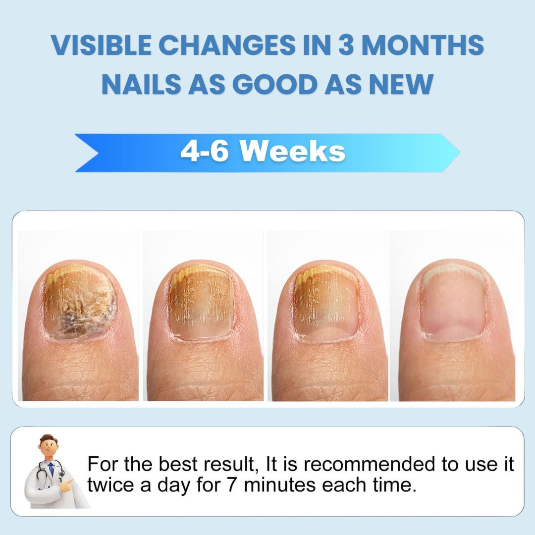 FungeeFree™ - Nail Fungus Laser