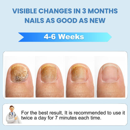 FungeeFree™ - Nail Fungus Laser